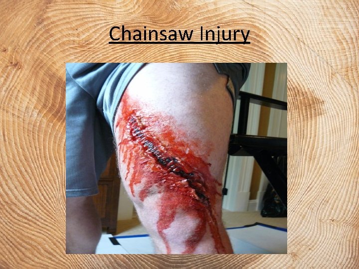 Chainsaw Injury 