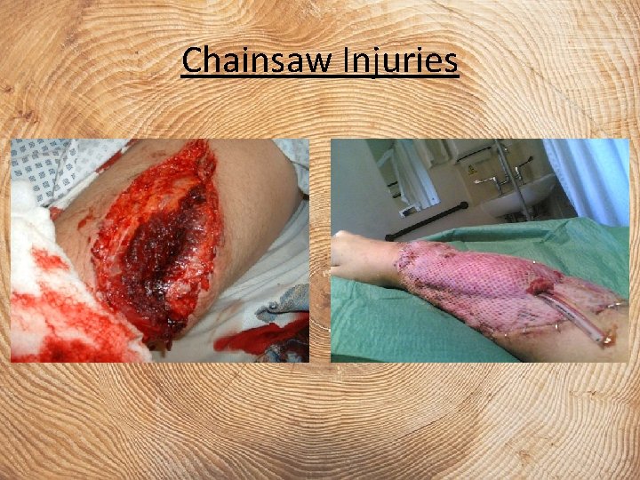 Chainsaw Injuries 