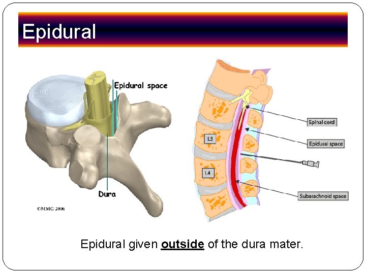Epidural given outside of the dura mater. Epidural given outside of the dura mater.