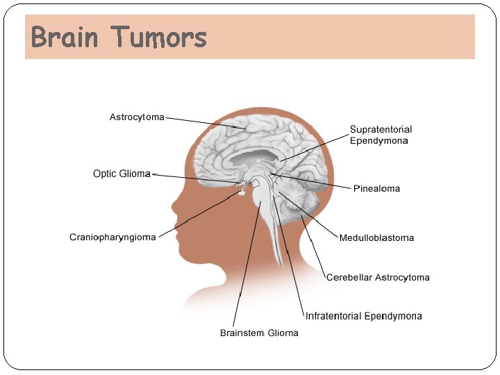 Brain Tumors Brain Tumors