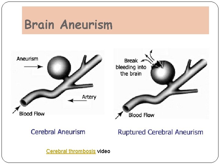 Brain Aneurism Cerebral thrombosis video Brain Aneurism Cerebral thrombosis video