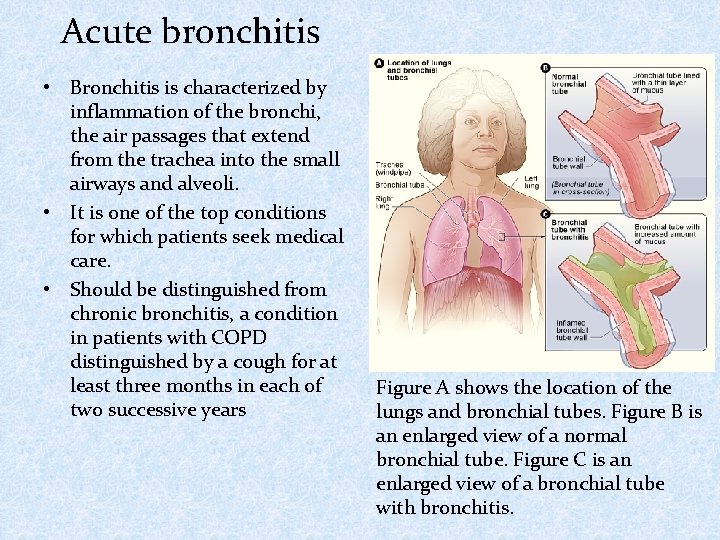 Acute bronchitis • Bronchitis is characterized by inflammation of the bronchi, the air passages