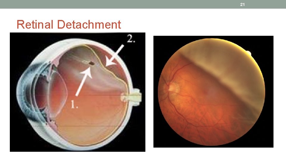 21 Retinal Detachment 