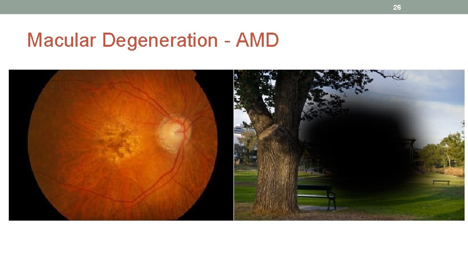 26 Macular Degeneration - AMD 