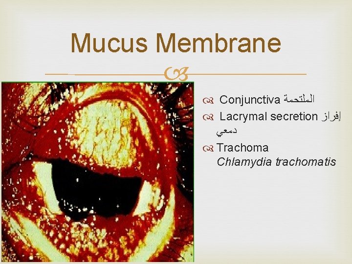 Mucus Membrane Conjunctiva ﺍﻟﻤﻠﺘﺤﻤﺔ Lacrymal secretion ﺇﻓﺮﺍﺯ ﺩﻣﻌﻲ Trachoma Chlamydia trachomatis 