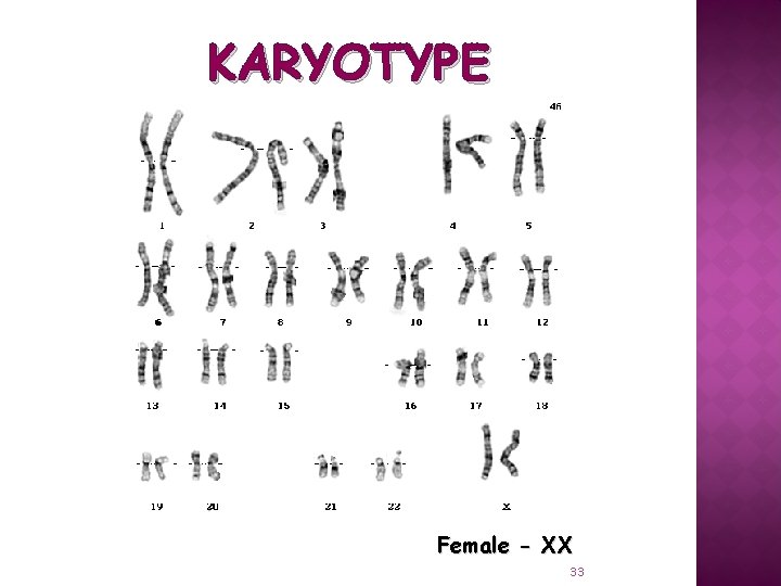KARYOTYPE Female - XX 33 