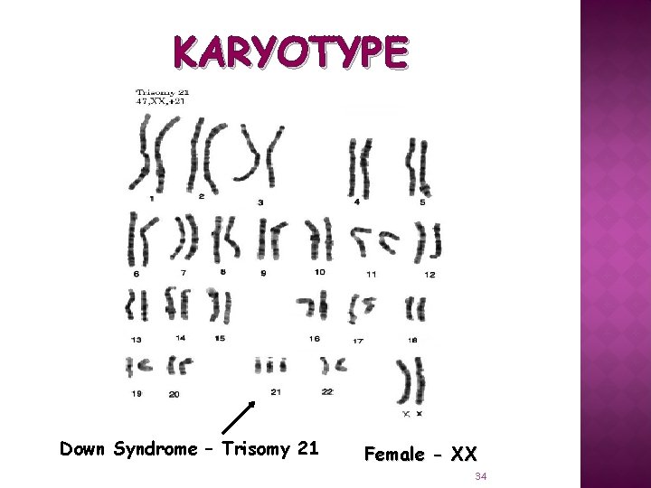 KARYOTYPE Down Syndrome – Trisomy 21 Female - XX 34 