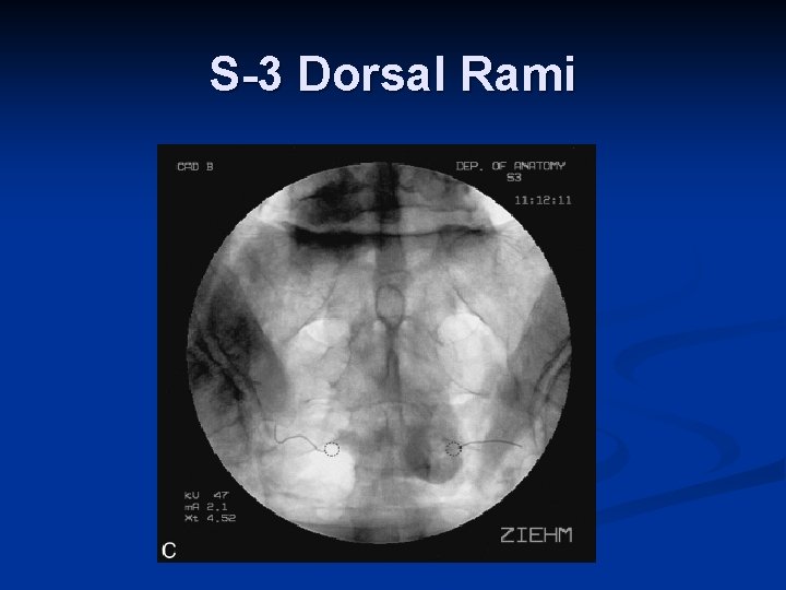S-3 Dorsal Rami S-3 Dorsal Rami
