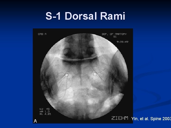 S-1 Dorsal Rami Yin, et al. Spine 2003 