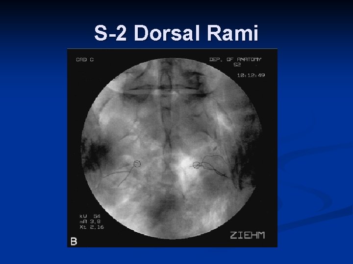 S-2 Dorsal Rami S-2 Dorsal Rami