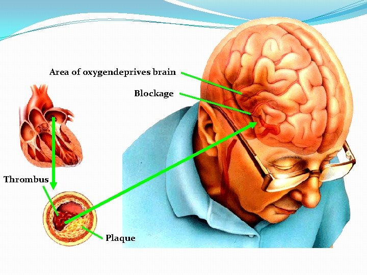 Area of oxygendeprives brain Blockage Thrombus Plaque 
