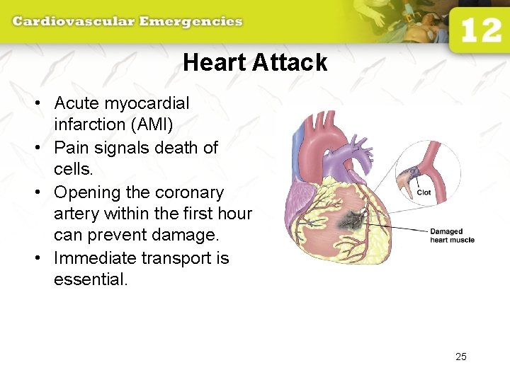 Heart Attack • Acute myocardial infarction (AMI) • Pain signals death of cells. •