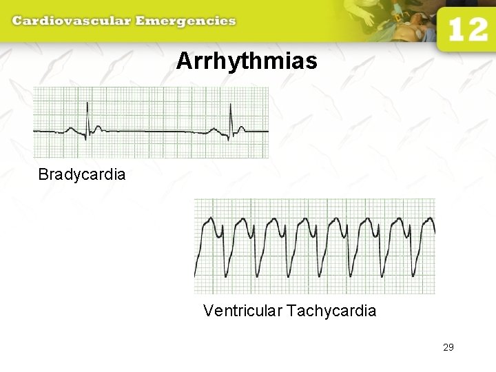 Arrhythmias Bradycardia Ventricular Tachycardia 29 