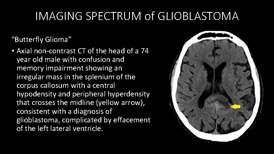 IMAGING SPECTRUM of GLIOBLASTOMA “Butterfly Glioma” • Axial non-contrast CT of the head of