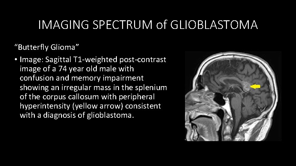 IMAGING SPECTRUM of GLIOBLASTOMA “Butterfly Glioma” • Image: Sagittal T 1 -weighted post-contrast image