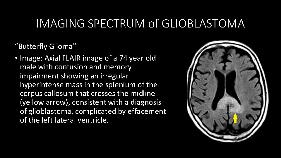 IMAGING SPECTRUM of GLIOBLASTOMA “Butterfly Glioma” • Image: Axial FLAIR image of a 74