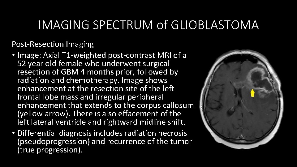 IMAGING SPECTRUM of GLIOBLASTOMA Post-Resection Imaging • Image: Axial T 1 -weighted post-contrast MRI