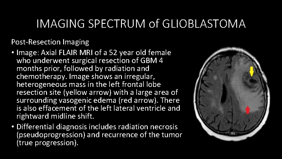 IMAGING SPECTRUM of GLIOBLASTOMA Post-Resection Imaging • Image: Axial FLAIR MRI of a 52