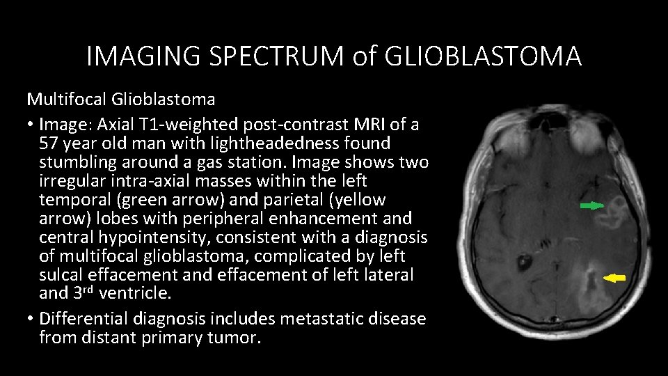 IMAGING SPECTRUM of GLIOBLASTOMA Multifocal Glioblastoma • Image: Axial T 1 -weighted post-contrast MRI