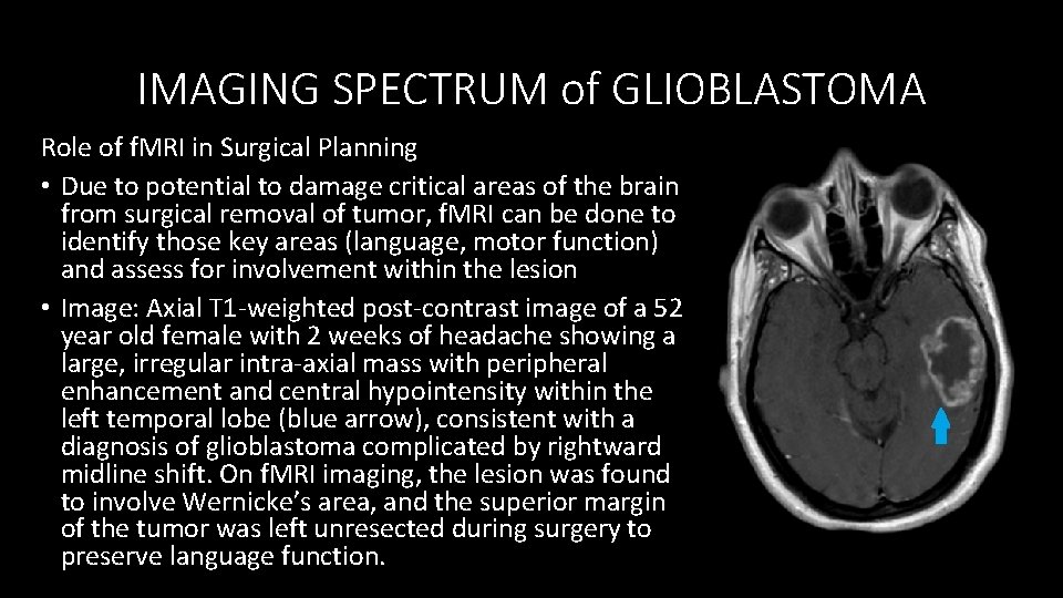 IMAGING SPECTRUM of GLIOBLASTOMA Role of f. MRI in Surgical Planning • Due to