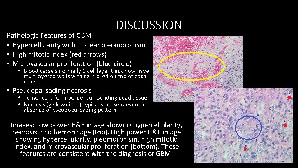 DISCUSSION Pathologic Features of GBM • Hypercellularity with nuclear pleomorphism • High mitotic index