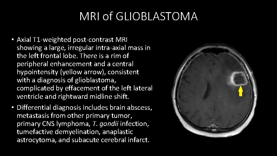 MRI of GLIOBLASTOMA • Axial T 1 -weighted post-contrast MRI showing a large, irregular