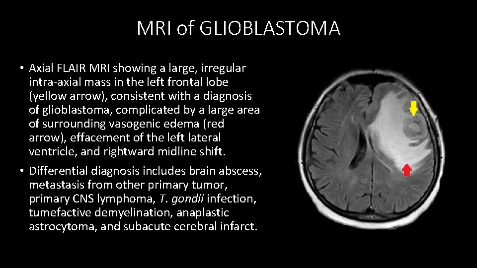 MRI of GLIOBLASTOMA • Axial FLAIR MRI showing a large, irregular intra-axial mass in