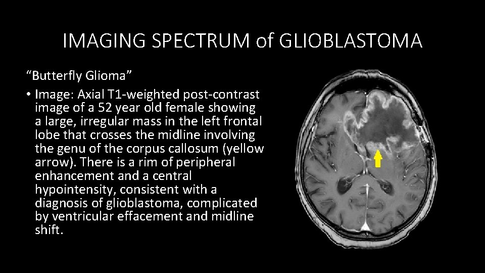 IMAGING SPECTRUM of GLIOBLASTOMA “Butterfly Glioma” • Image: Axial T 1 -weighted post-contrast image