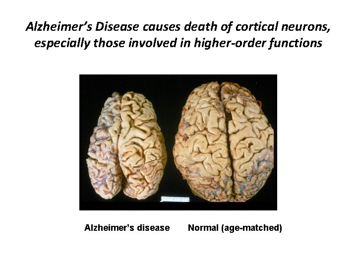 Alzheimer’s Disease causes death of cortical neurons, especially those involved in higher-order functions Alzheimer’s