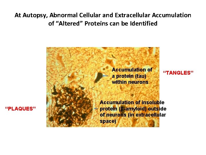 At Autopsy, Abnormal Cellular and Extracellular Accumulation of “Altered” Proteins can be Identified Accumulation