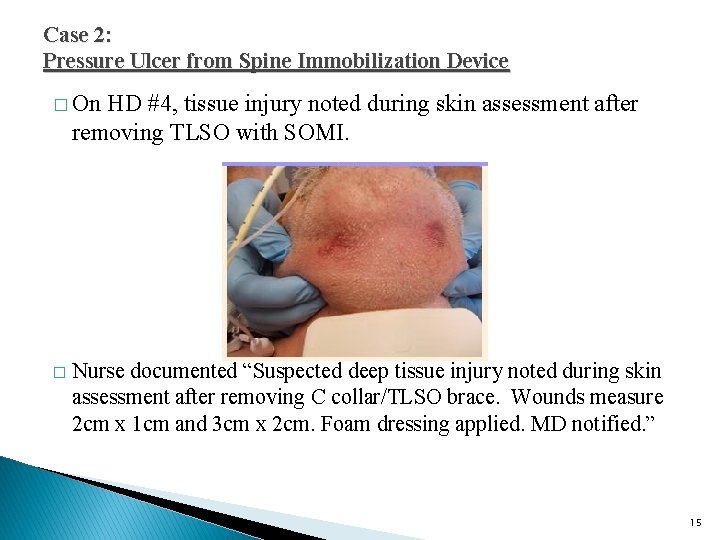 Case 2: Pressure Ulcer from Spine Immobilization Device � On HD #4, tissue injury