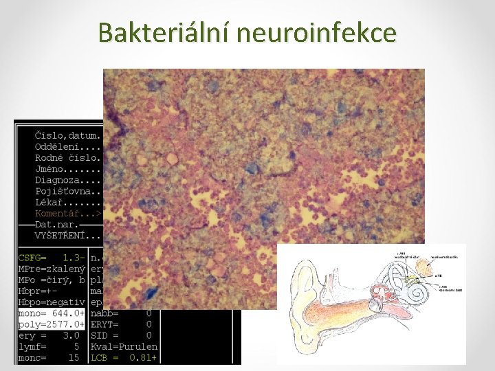 Bakteriální neuroinfekce 