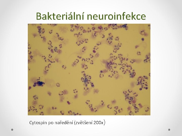 Bakteriální neuroinfekce Cytospin po naředění (zvětšení 200 x) 
