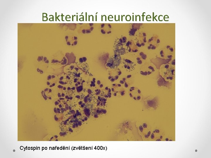 Bakteriální neuroinfekce Cytospin po naředění (zvětšení 400 x) 