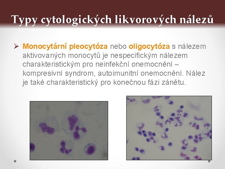 Typy cytologických likvorových nálezů Ø Monocytární pleocytóza nebo oligocytóza s nálezem aktivovaných monocytů je