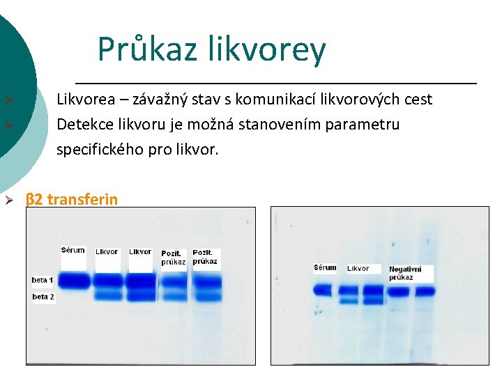 Průkaz likvorey Ø Ø Ø Likvorea – závažný stav s komunikací likvorových cest Detekce