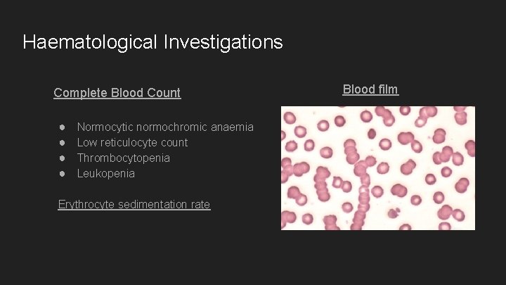 Haematological Investigations Complete Blood Count ● ● Normocytic normochromic anaemia Low reticulocyte count Thrombocytopenia