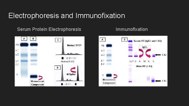 Electrophoresis and Immunofixation Serum Protein Electrophoresis Immunofixation 