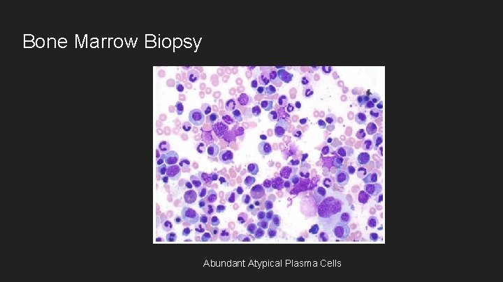 Bone Marrow Biopsy Abundant Atypical Plasma Cells 