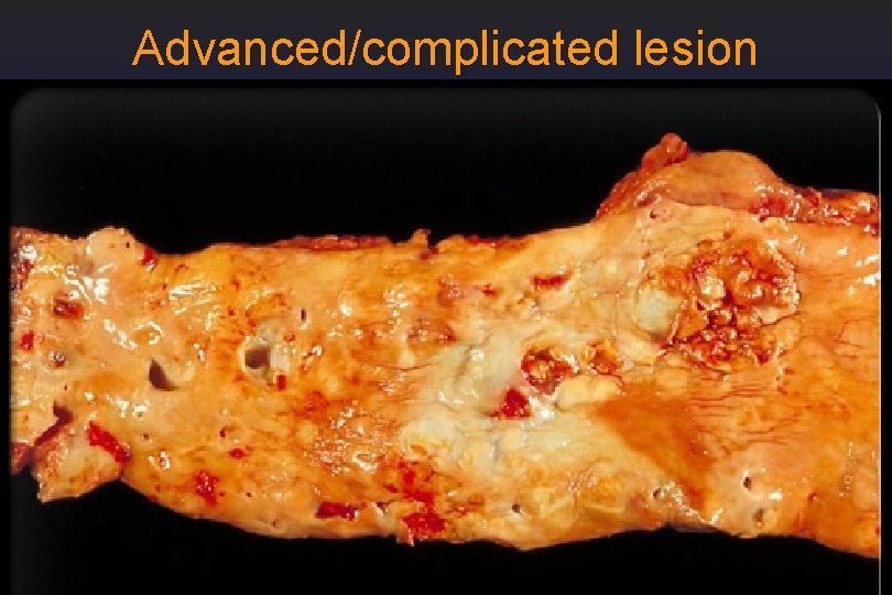 Advanced/complicated lesion 