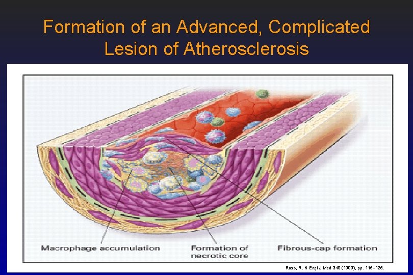 Formation of an Advanced, Complicated Lesion of Atherosclerosis Ross, R. N Engl J Med
