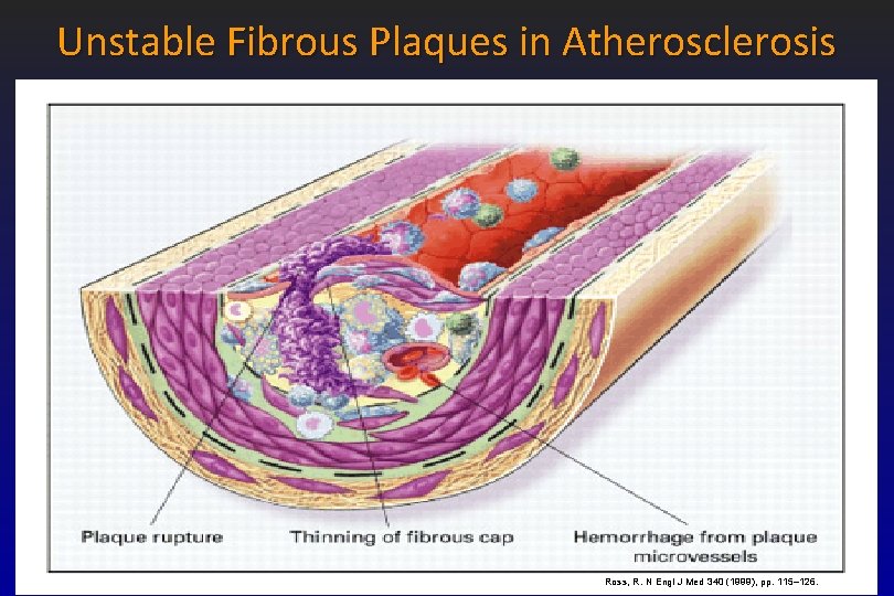 Unstable Fibrous Plaques in Atherosclerosis Ross, R. N Engl J Med 340 (1999), pp.