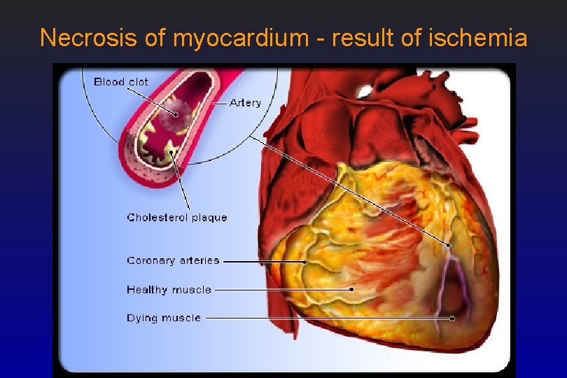 Necrosis of myocardium - result of ischemia 