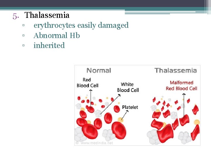 5. Thalassemia ▫ ▫ ▫ erythrocytes easily damaged Abnormal Hb inherited 