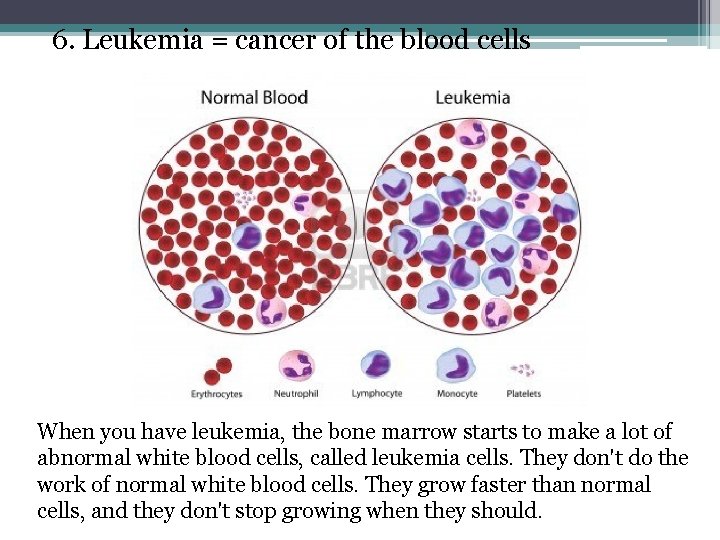 6. Leukemia = cancer of the blood cells When you have leukemia, the bone