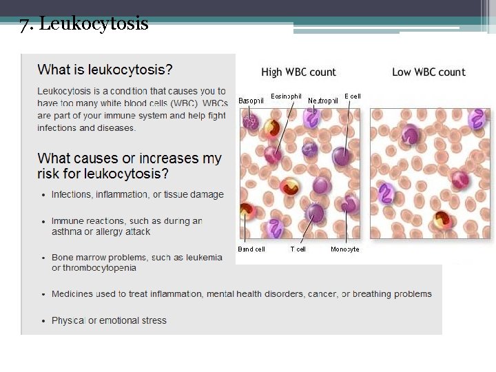 7. Leukocytosis 