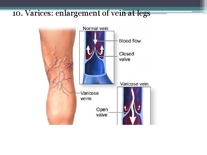 10. Varices: enlargement of vein at legs 