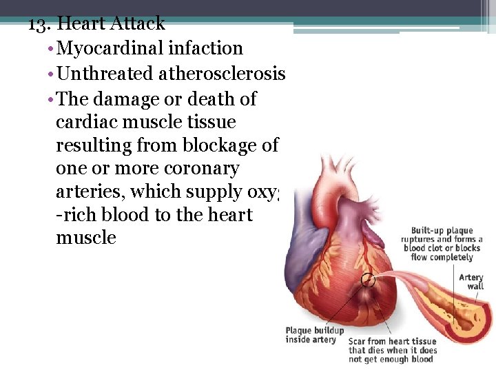 13. Heart Attack • Myocardinal infaction • Unthreated atherosclerosis • The damage or death