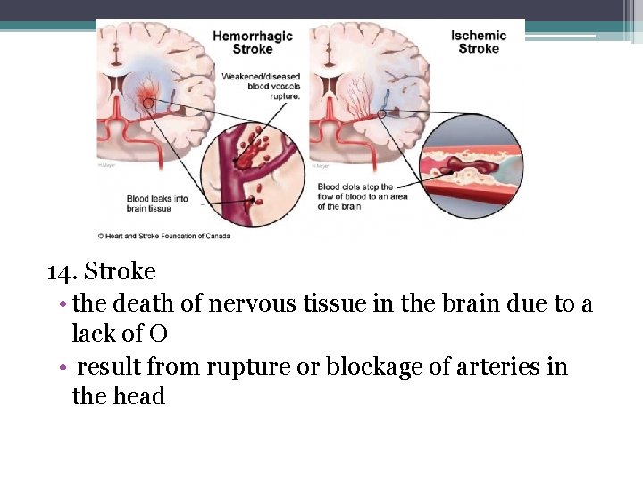 14. Stroke • the death of nervous tissue in the brain due to a