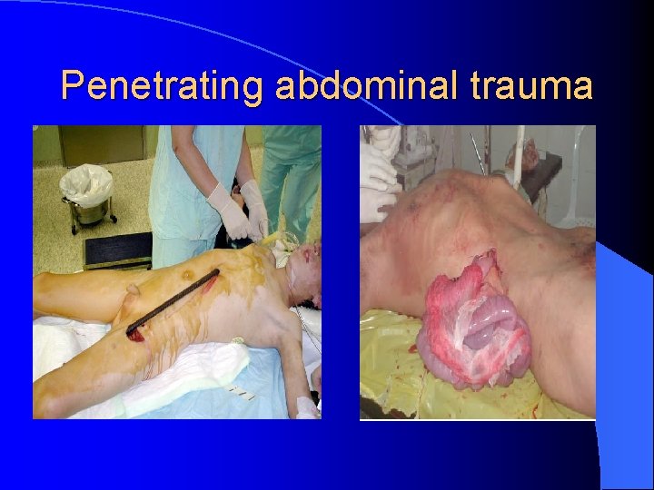 Penetrating abdominal trauma Penetrating abdominal trauma